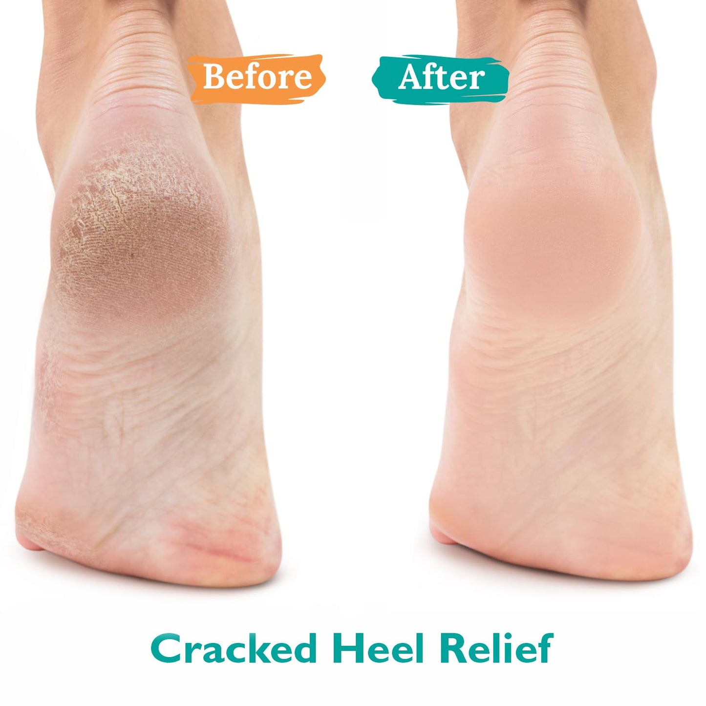 Urea Gel 42 Percent For Feet Maximum Strength Softens Cracked Heel Calluses & Thick Toenails