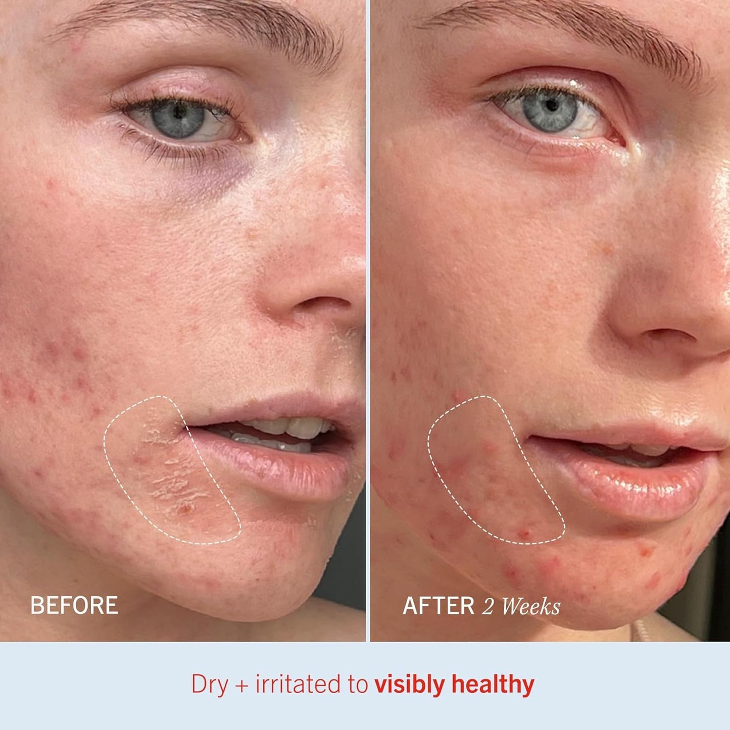 First Aid Beauty - Ultra Repair Cream, Intense Hydration Whipped Colloidal Oatmeal, Clinically Proven to Strengthen Skin Barrier & Help Relieve Eczema, Face & Body Moisturizer, 14oz Juicy Peach