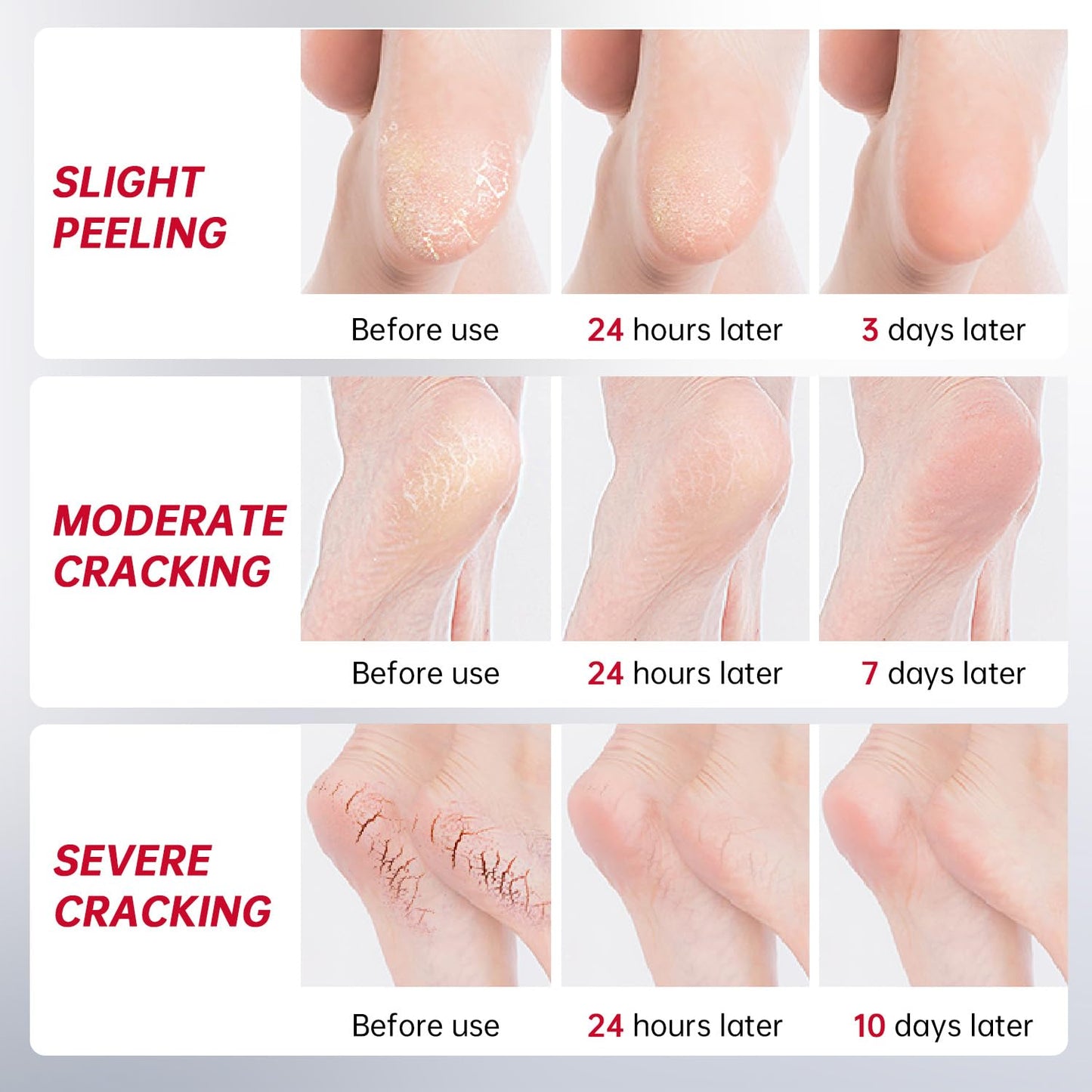 Urea Cream 40 Percent for Feet Maximum Strength, with Heel Protectors, Foot Moisturizer Cream for Dry Cracked Heels Rough Dead Dry Skin Foot Callus Remover - 5.29 Oz