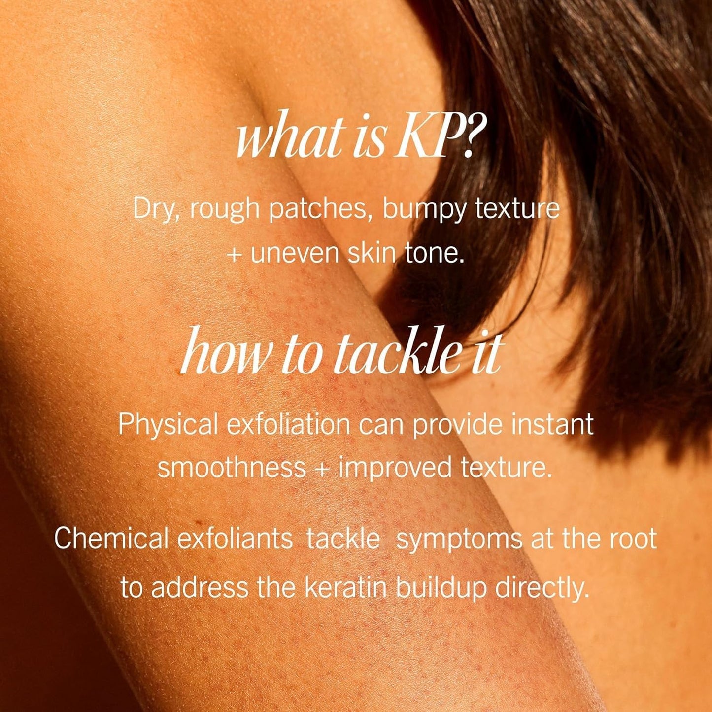 First Aid Beauty - KP Bump Eraser Body Scrub with 10% AHA, Keratosis Pilaris Exfoliator with Glycolic and Lactic acids, Helps Reduce Chicken Skin Bumps, Safe for Sensitive Skin, Strawberry Scent, 8 oz